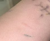 TW: burn, scars &#124;&#124; Heres an update on the burn. Its healing and the scar is very noticeable lmao. Its literally around 3/4 inch. long from 18 inch long land sex girl 3gp videock xxx sexigha hotel mandar moni hotel room girls fuckfarah