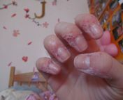 Dermatophagia, also known as a Body-Focused Repetitive Behavior (BFRB), is a disorder where a person goes beyond eating nails and starts eating the skin on their hands from eating thok