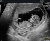 #First Pregnancy scan.. Sharing my wife&#39;s first pregnancy scan report to all the beloved users here. Her bull impregnated her on December and she is now carrying his seed. I am truly excited to get this first scan report.. Dream come true moments of m from 1time facksl nadu first