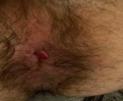 Hello, I am a 20 yo male who is dealing with an anal fissure for about 2 months. First, I started with a lot of pain and spasms of my IAE. However rn I am seeing a lot of blood, a skin tag and no pain. Whats going rn? Thank u, from pain and vocie h