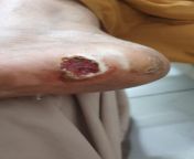 Aunt had corn removal surgery on her foot 6 days back. While changing the dressing, i noticed this from neha mehta xxx hot sexi video while changing 2