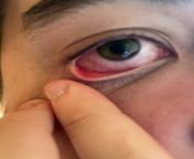 Eye is really itchy and red , seems to be a little clear thing at the corner of the eye that isnt on the other eye from masturbate at the corner of the desk and real orgasm