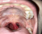 M17, extremely swolen uvula, pain in throat since Saturday, uvula since monday morning. More in com. from uvula nnyo wa nyovha