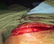 My skin burst from landing on flat pavement with a bent knee. from balen hukana vidi