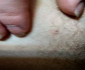 long time lurker, first time poster. a blackhead on my inner thigh, I thought it was an ingrown hair so I take a second in the middle to try and pick at it from desi virgin pussy pussy first time fucking mp4 desiscreenshot preview