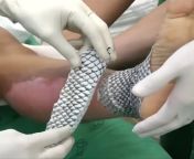 Fish skin removes skin burns. Brazilian scientists use fish skin in the treatment of burns. Thanks to the collagen and high humidity in the fish skin, the burned skin of the patients heals quickly without leaving any pain or scars. from mitchell burns