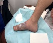 My buddy spilled boiling water onto his foot and burned it badly. His girlfriend decided to film the doctor cutting the burned skin off a few weeks later. (His foot has healed perfectly with minimal scarring.) I&#39;ve had this video for a few months butfrom chachi ki choot it pradesh his mms