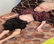 The child Rasha Alwan suffers from phenylketonuria, which threatens death due to malnutrition and dehydration, and is in the shelter camps in Deir al-Balah from rasha junaid