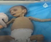 Malnourished Daily arrival of sick children at Kamal Adwan Hospital (caption translated via IG) from palestine caption