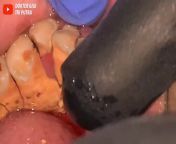 Huge tartar buildup removed by a dentist from tamil nadu aunty saree removed by a boyhouse wife aunty thoppul navel press majadestiny deville sex the indian pornstartamil actress boomika real sex video download girl bathi