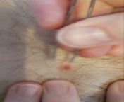 Pimple and an ingrown hair on SO&#39;s groin area - no ween visible. from hair j