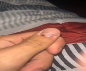 Checkup on the finger rip the spot has nail bed grown back but a lack of nail growing should I go to the doctor and get it all cut off and start from base 1 or wait it what do I do from doctor and nurse sex 4gp videollege mms